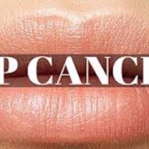 What is lip cancer? – Various reasons for lip cancer and treatments etc!!