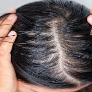 Say goodbye to the issue of greasy and oily hairs by these superb home remedies!!