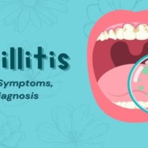 Tonsillitis – Various important things to know!!