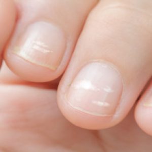 If you have white spots on your nails, then you might have these health issues!!