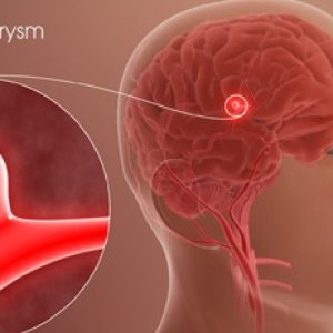 Brain Aneurysm – symptoms, risk factors and treatments etc – Important things to know!!