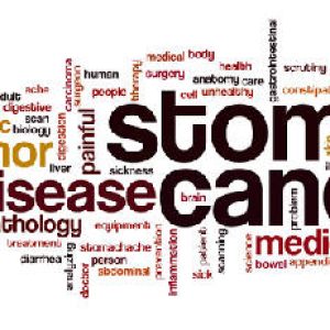 Stomach cancer can occur in us due to these habits, please be careful and take care!!