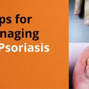 Nail psoriasis condition, its signs and treatments etc – Important things to know!!